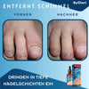 ToePerfect™ | Heals Toenails and Fingernails