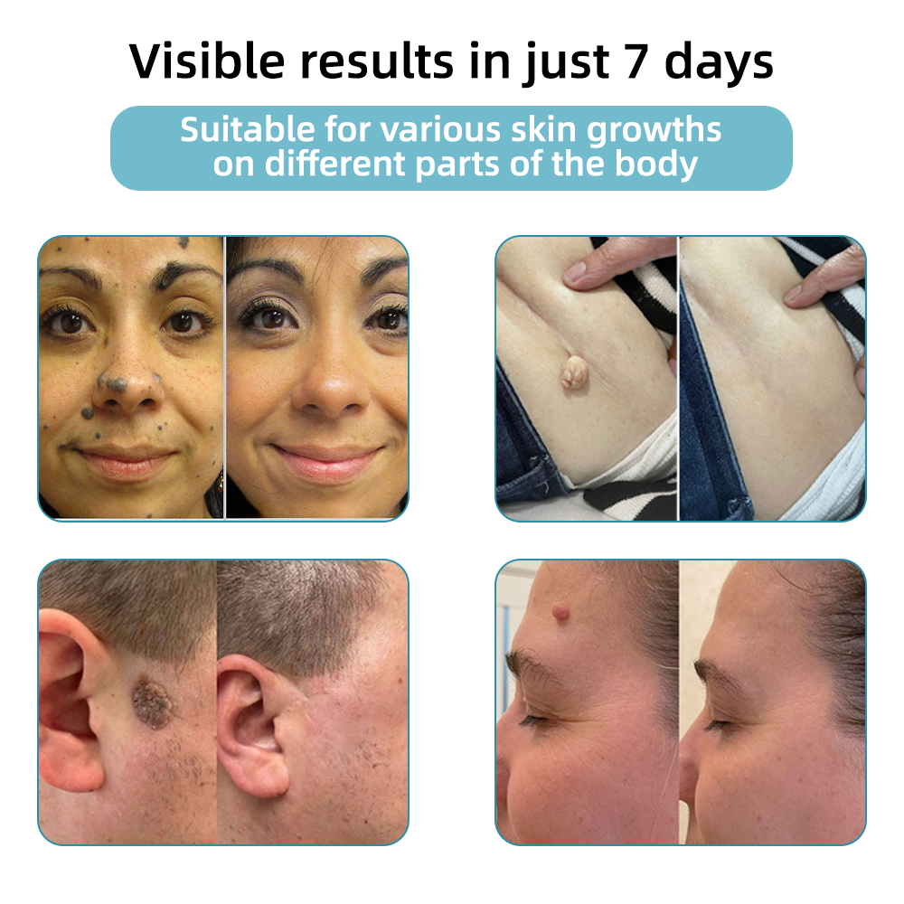 Bikenda™ | Non-Invasive Mole and Wart Removal Laser Pen Promax