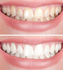 Smiley™ - Teeth Whitener