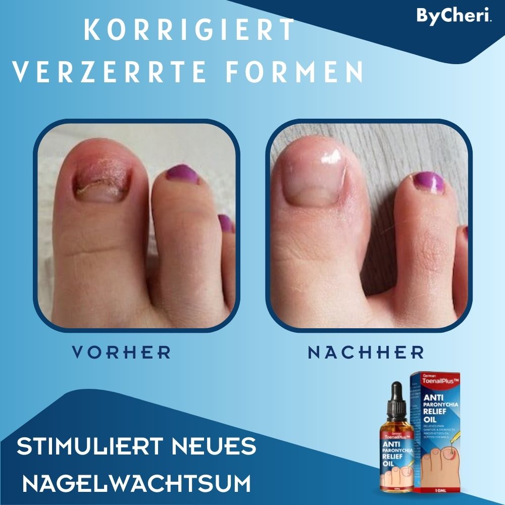 ToePerfect™ | Heals Toenails and Fingernails