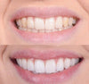 Smiley™ - Teeth Whitener