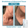Bikenda™ | Non-Invasive Mole and Wart Removal Laser Pen Promax