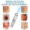 Bikenda™ | Non-Invasive Mole and Wart Removal Laser Pen Promax