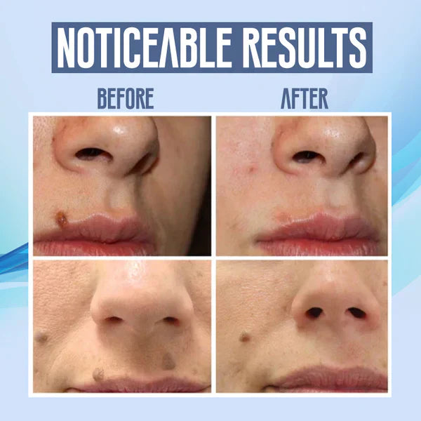 SpotClear™ | Dark Spot Vanisher in just Few Weeks