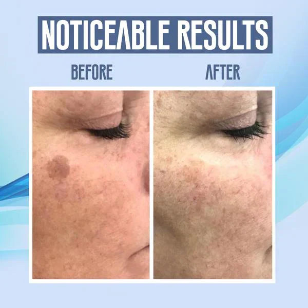 SpotClear™ | Dark Spot Vanisher in just Few Weeks