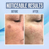 SpotClear™ | Dark Spot Vanisher in just Few Weeks