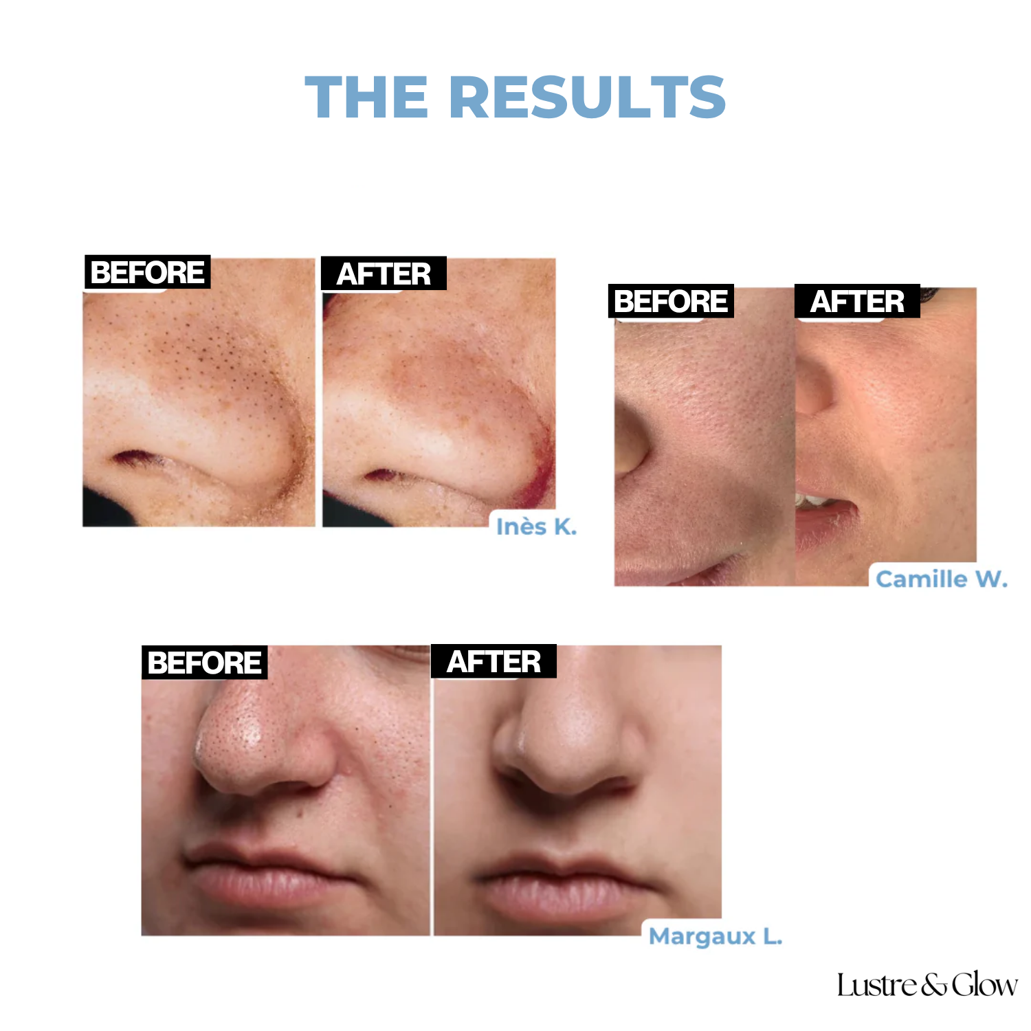 ViyaClean™ | Serum That Targets Clogged Pores For Flawless Skin