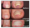 【LAST DAY SALE】Easy Patches™ - Correction Patches For Beautiful And Healthy Nails