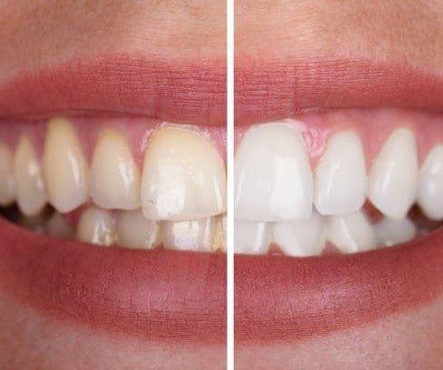 SmileKit™ | Feel more confident with a fresh, radiant smile that lasts