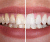 SmileKit™ | Feel more confident with a fresh, radiant smile that lasts