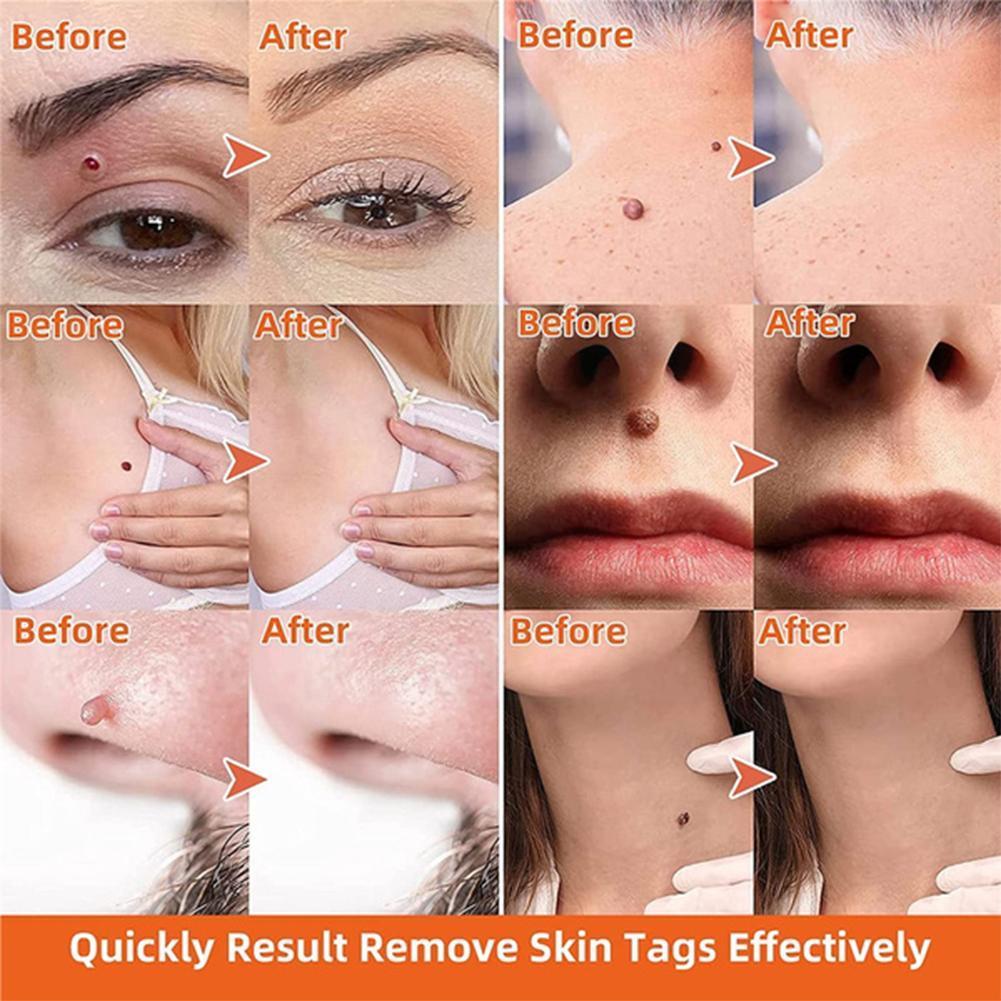 Painless Auto Skin Tag Remover Kit