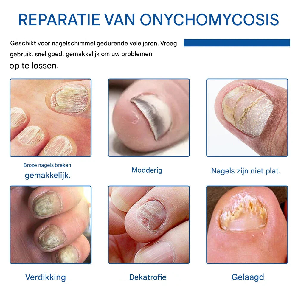 Nailox™ – Effective Nail Fungus Treatment