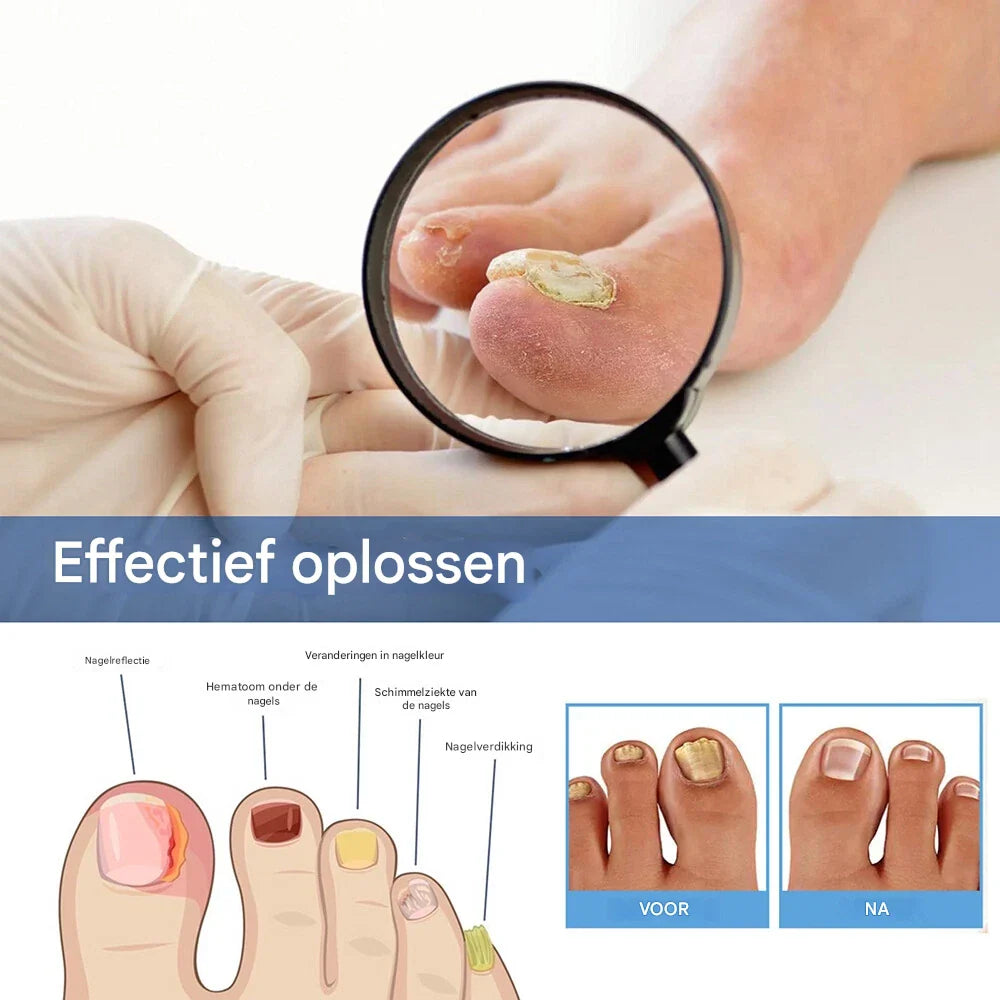 Nailox™ – Effective Nail Fungus Treatment
