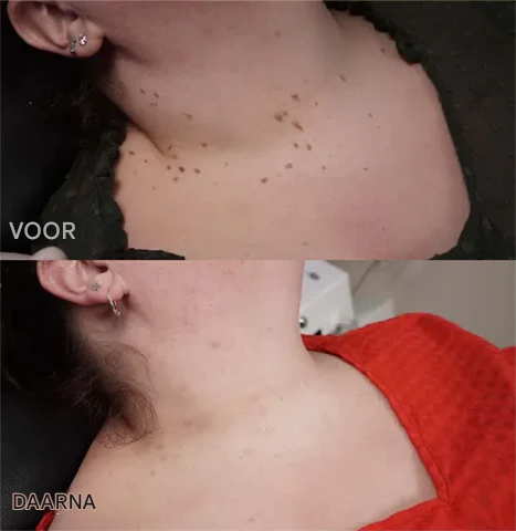 BeeNaturale™ – Gently Removes Skin Tags and Blemishes