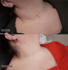 BeeNaturale™ – Gently Removes Skin Tags and Blemishes